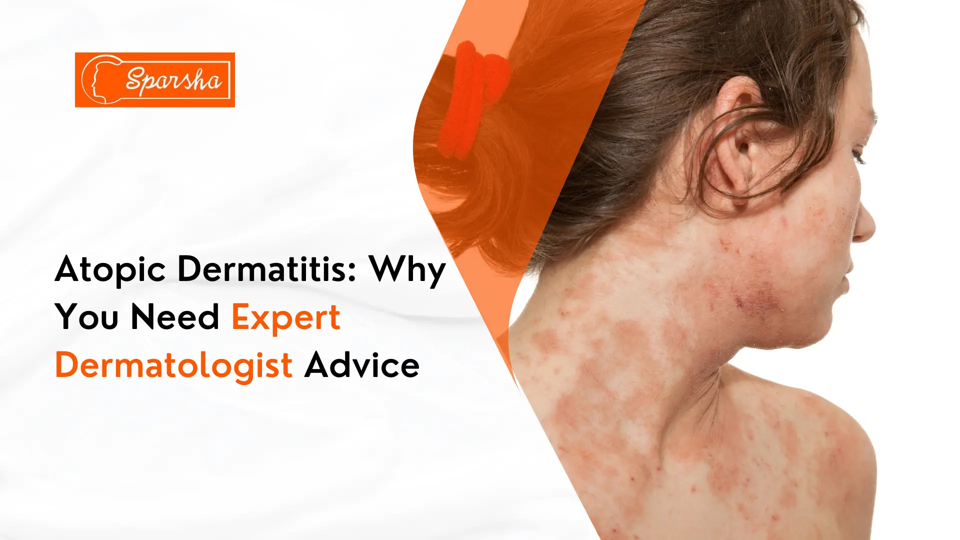 Skin Tag Removal Treatment in RR Nagar