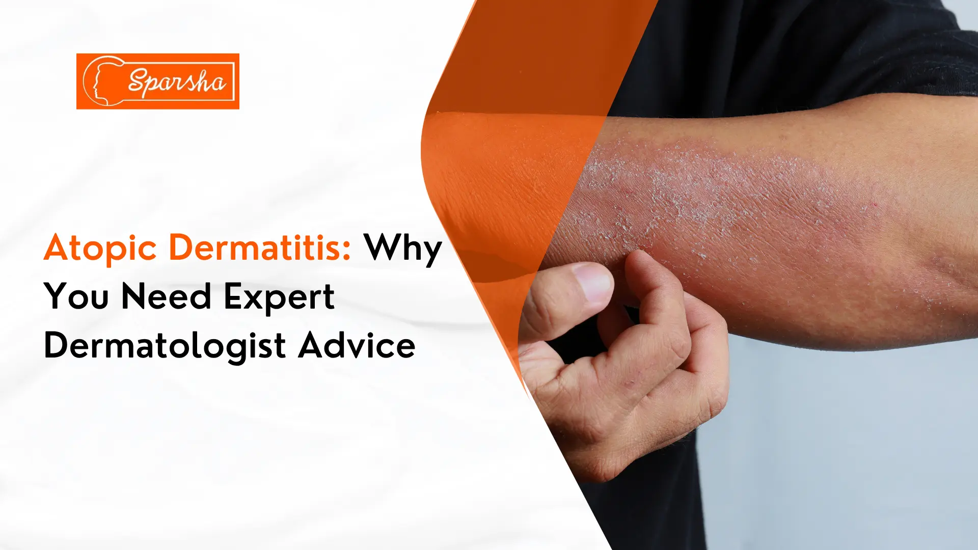 Skin Tag Removal Treatment in RR Nagar