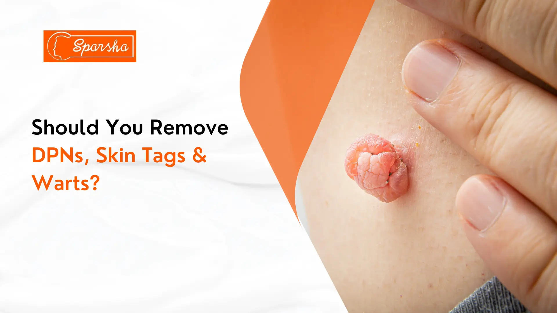 Skin Tag Removal Treatment in RR Nagar