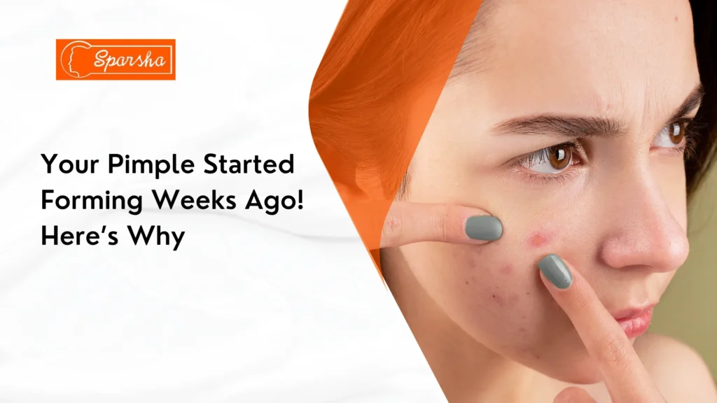 Acne Scar Treatment in RR Nagar